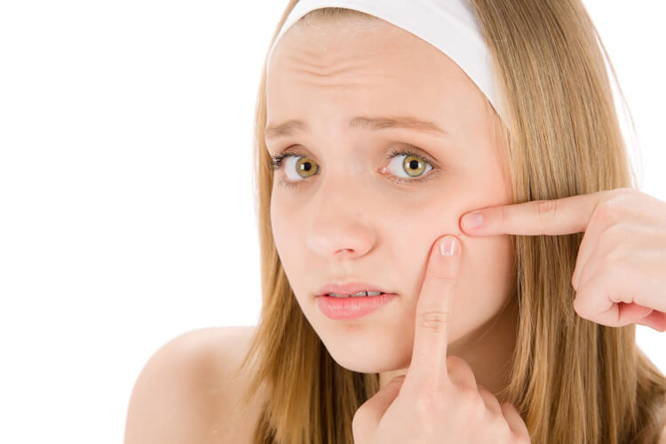 how-to-get-rid-of-acne-naturally