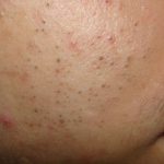 How to Get Rid of Blackheads Fast 15 Ways
