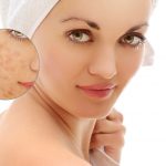 How to Get Rid of Pimples OverNight (15 Ways) How to get rid of pimples