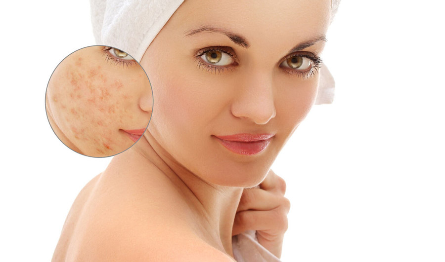 how to get rid of pimples with stuff at home