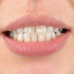 How to get rid of White Spots on Teeth? How to get rid of white spot on teeth