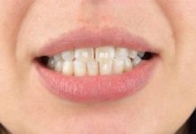 How to get rid of White Spots on Teeth? How to get rid of white spot on teeth