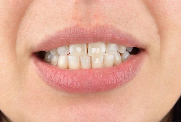 How to get rid of white spot on teeth